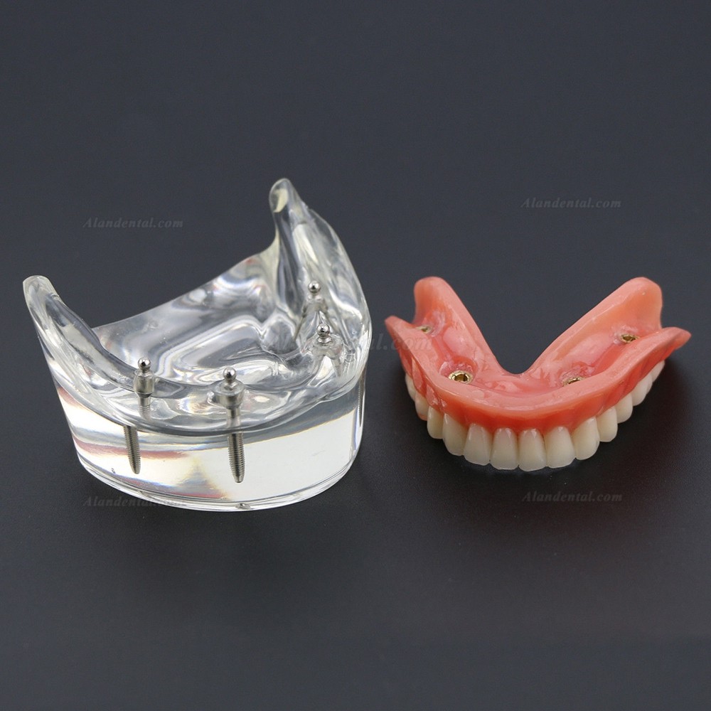 Dental Lower Teeth Demo Study Model 6002 02 Overdenture Inferior 4 Implants